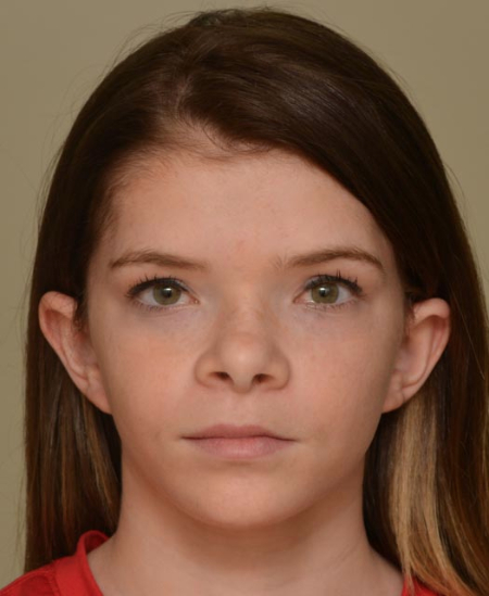 Patient # 51847 After Photo # 2