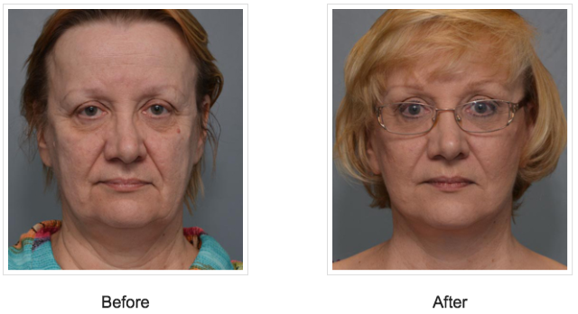 before and after cosmetic surgery new orleans