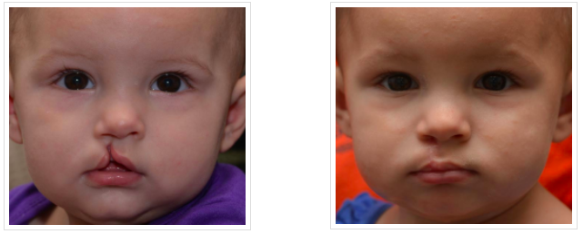 craniofacial before and after new orleans