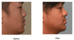 young man before and after rhinoplasty