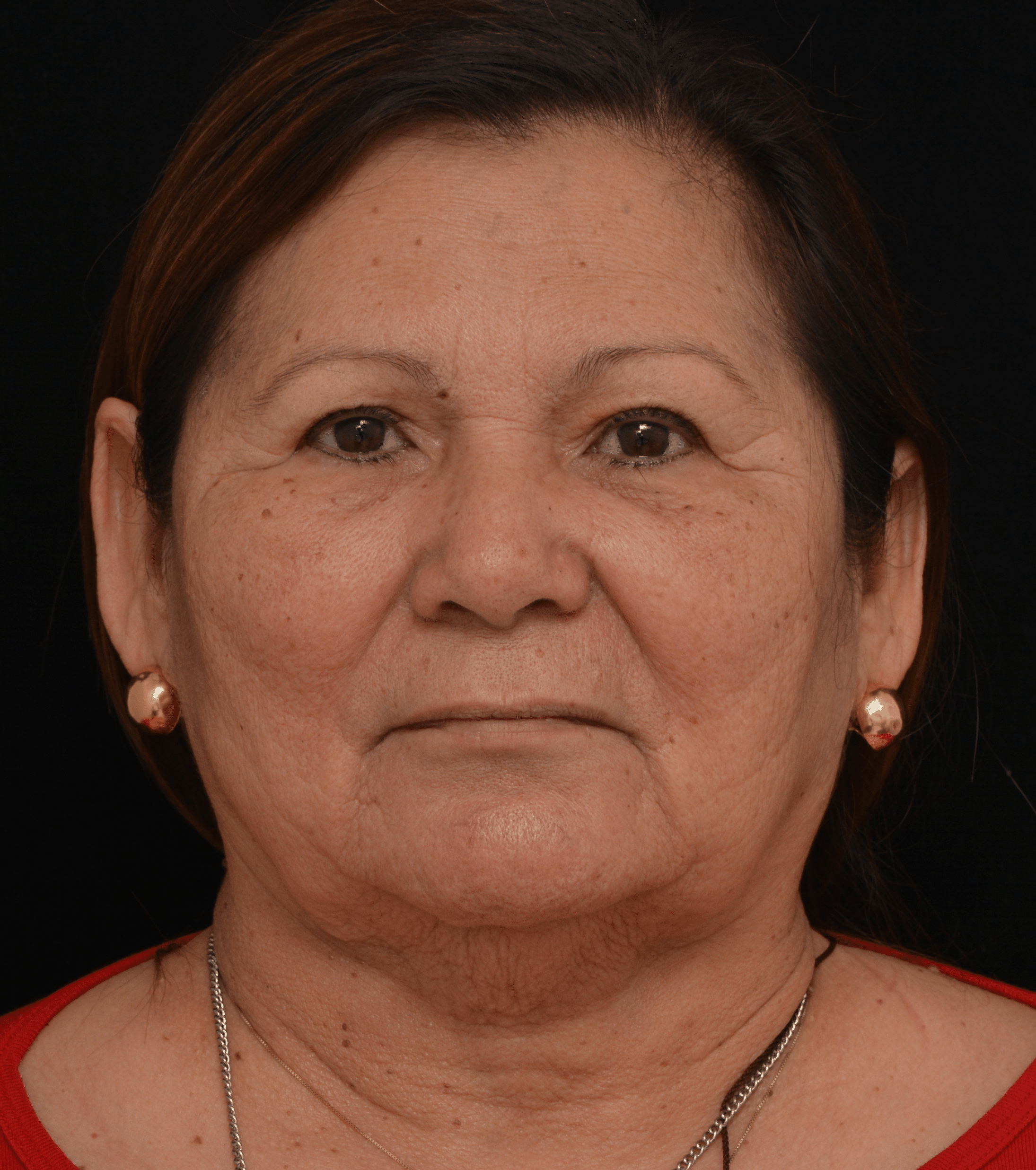 Before Image: Brow Lift - front