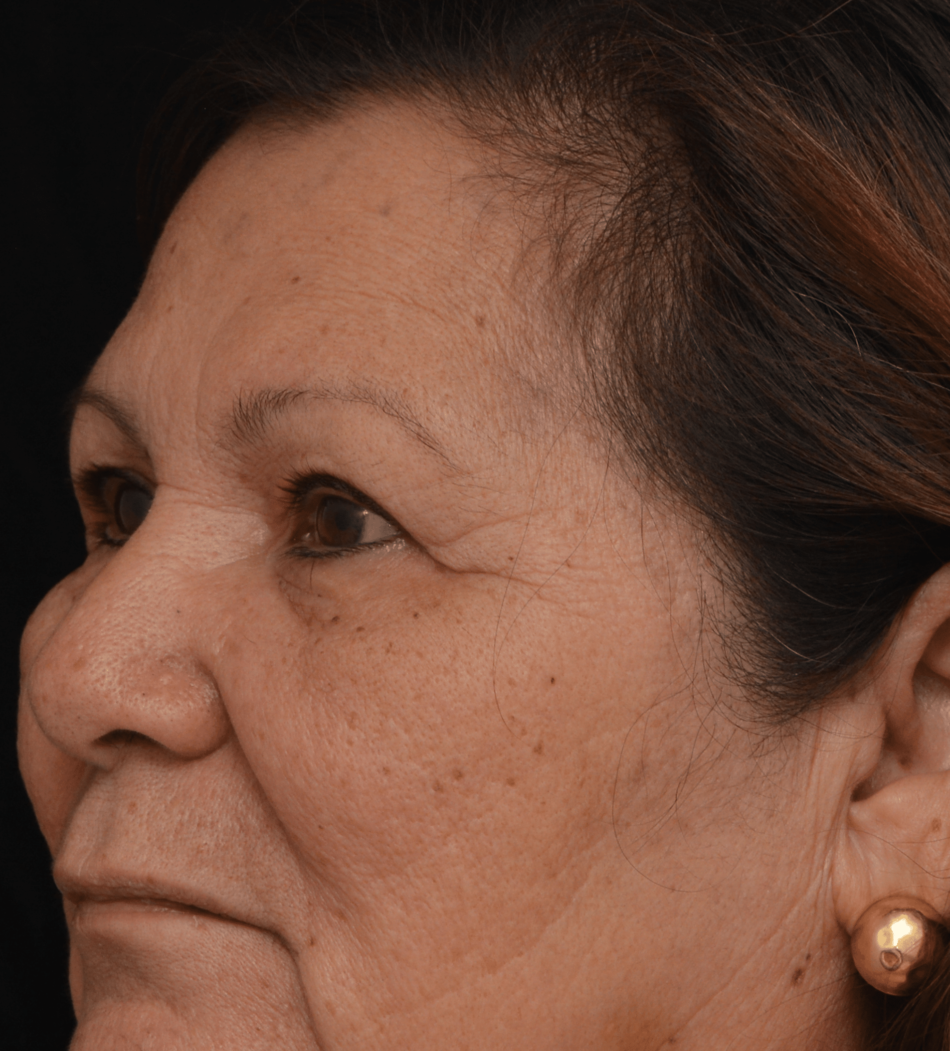 Before Image: Brow Lift - left-front-oblique