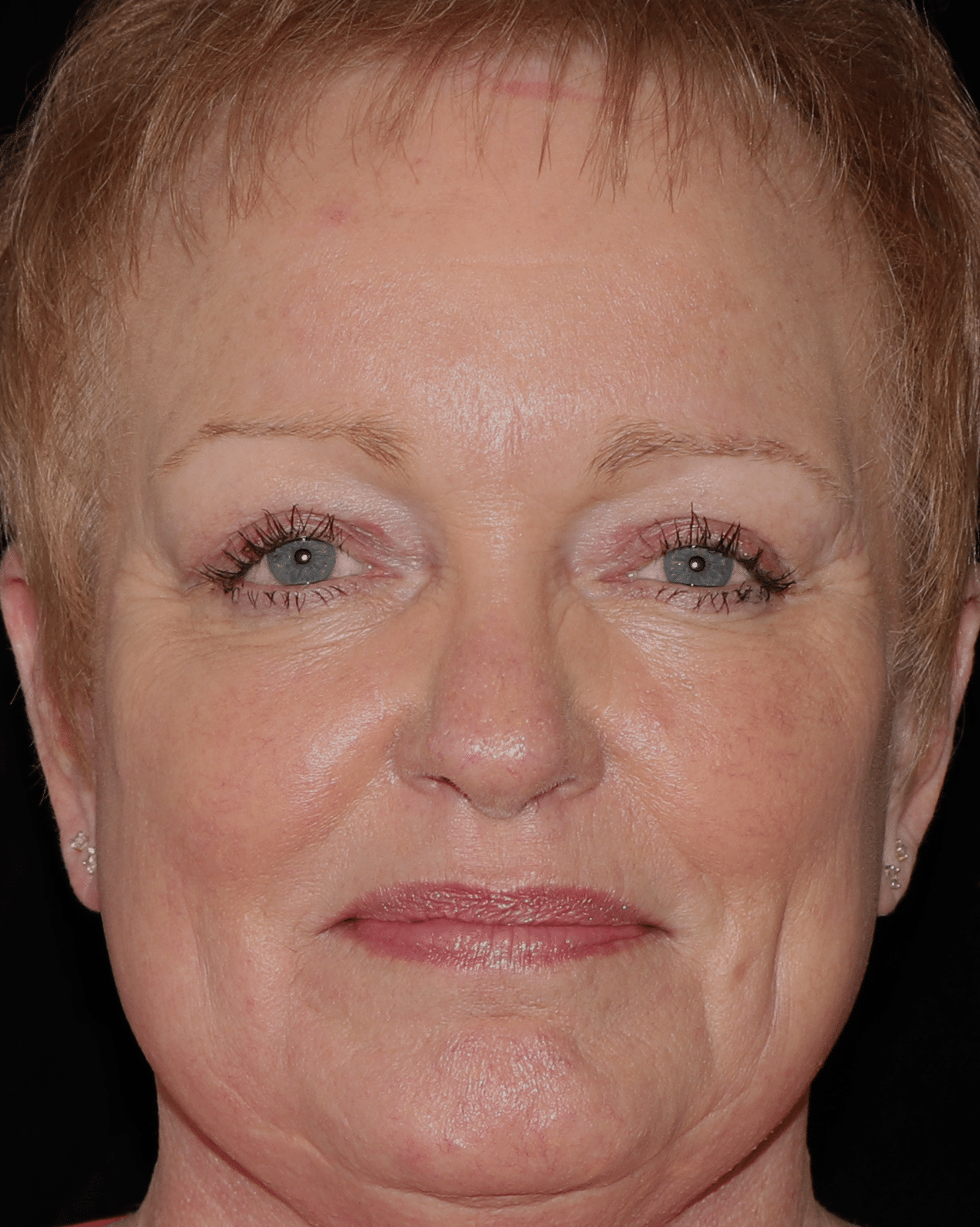 After Image: Brow Lift and Blepharoplasty - front