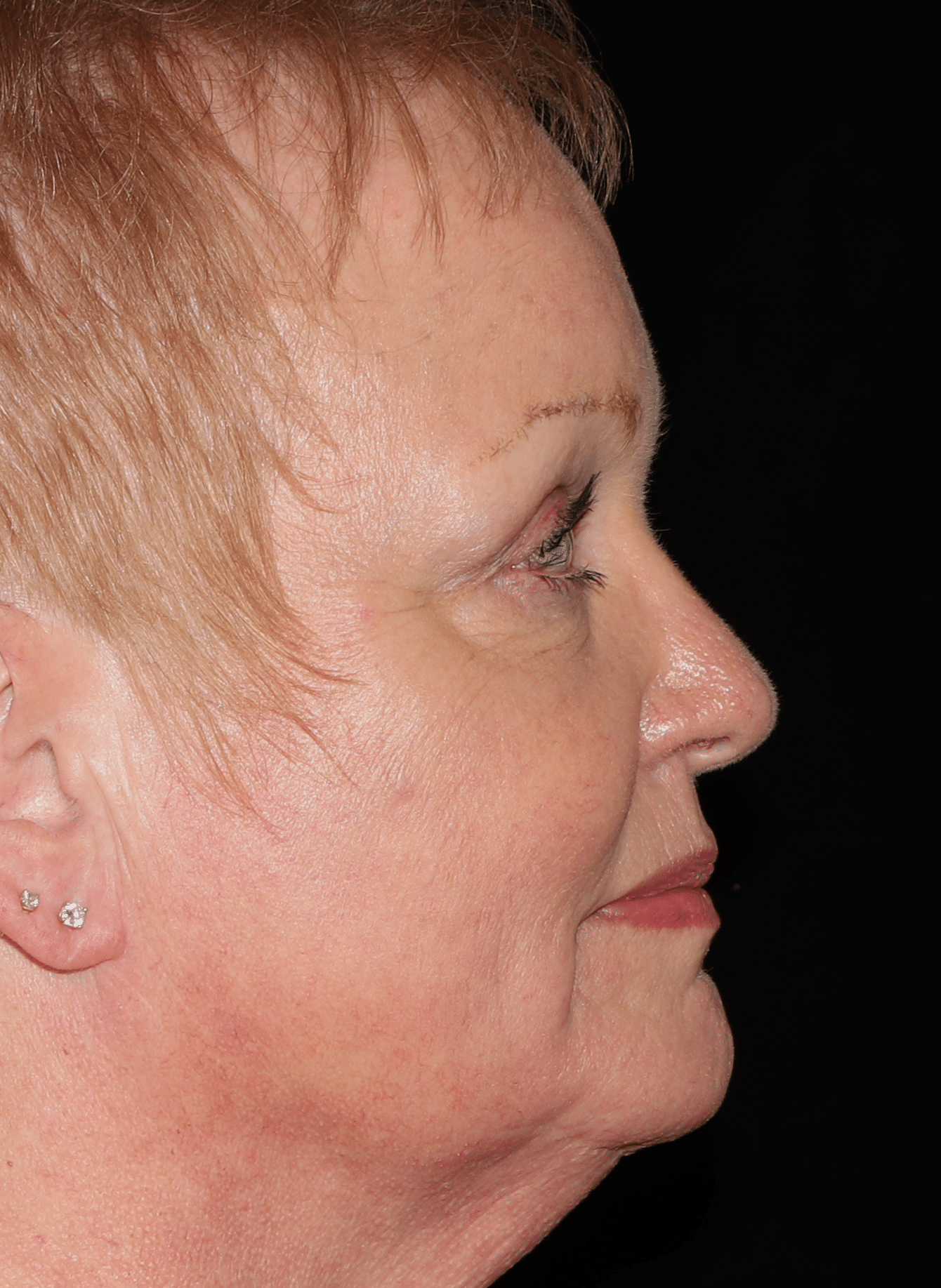 After Image: Brow Lift and Blepharoplasty - right-side