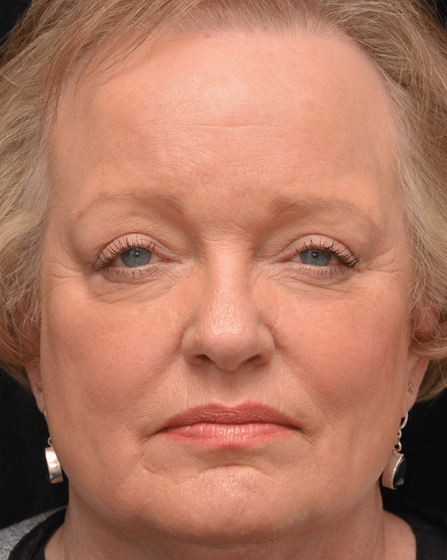 Before Image: Brow Lift and Blepharoplasty - front