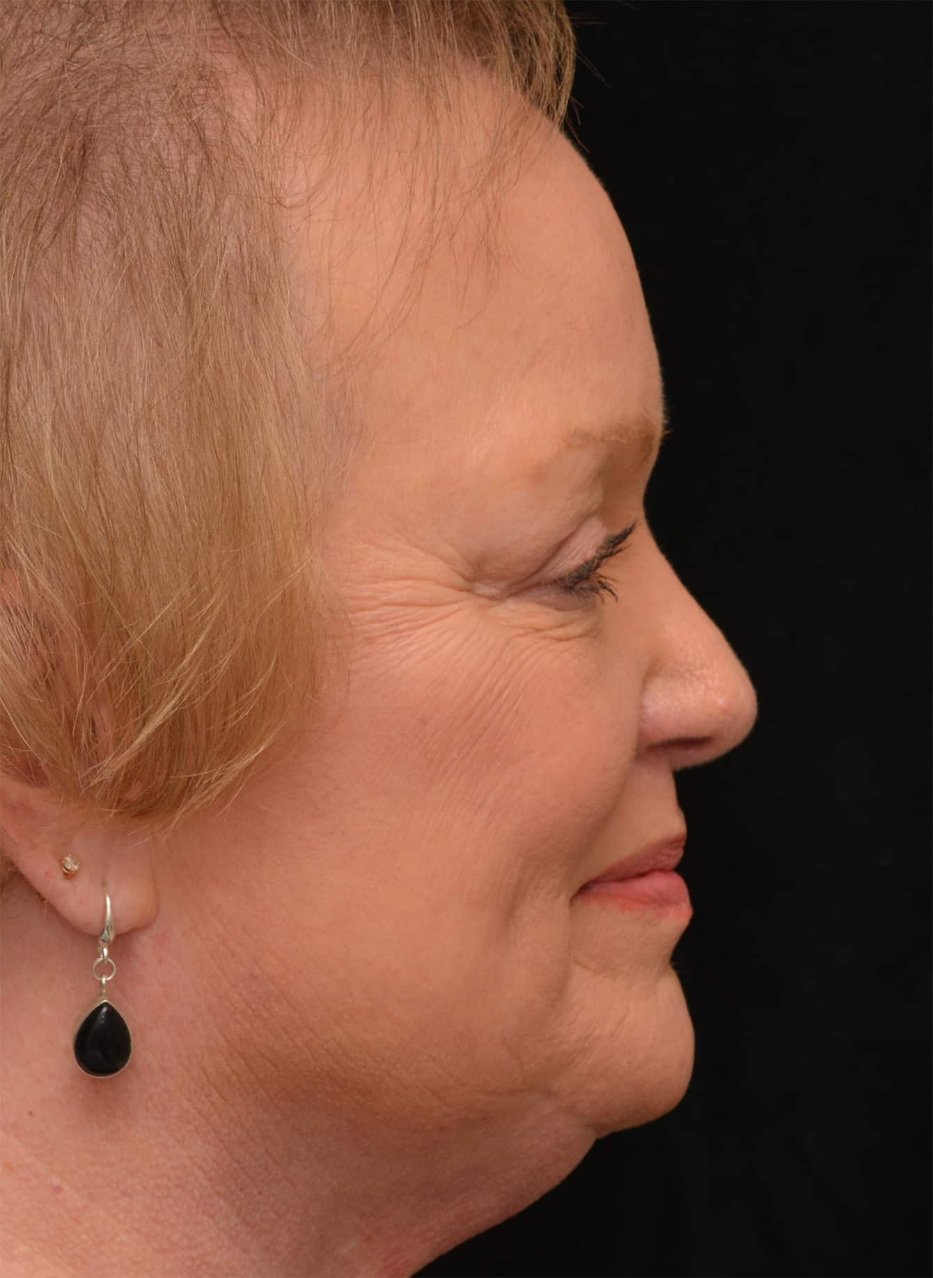 Before Image: Brow Lift and Blepharoplasty - right-side