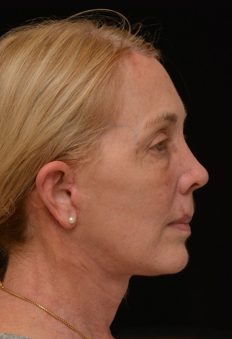 After Image: Facelift - right-side