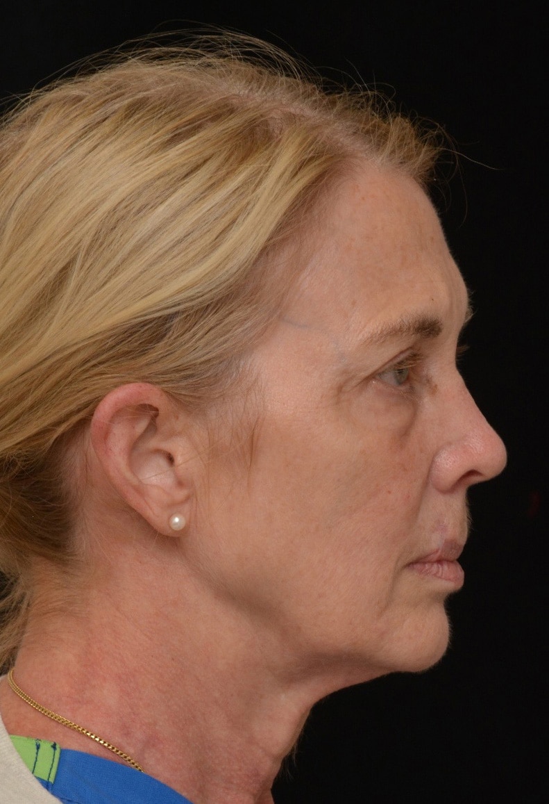 Before Image: Facelift - right-side