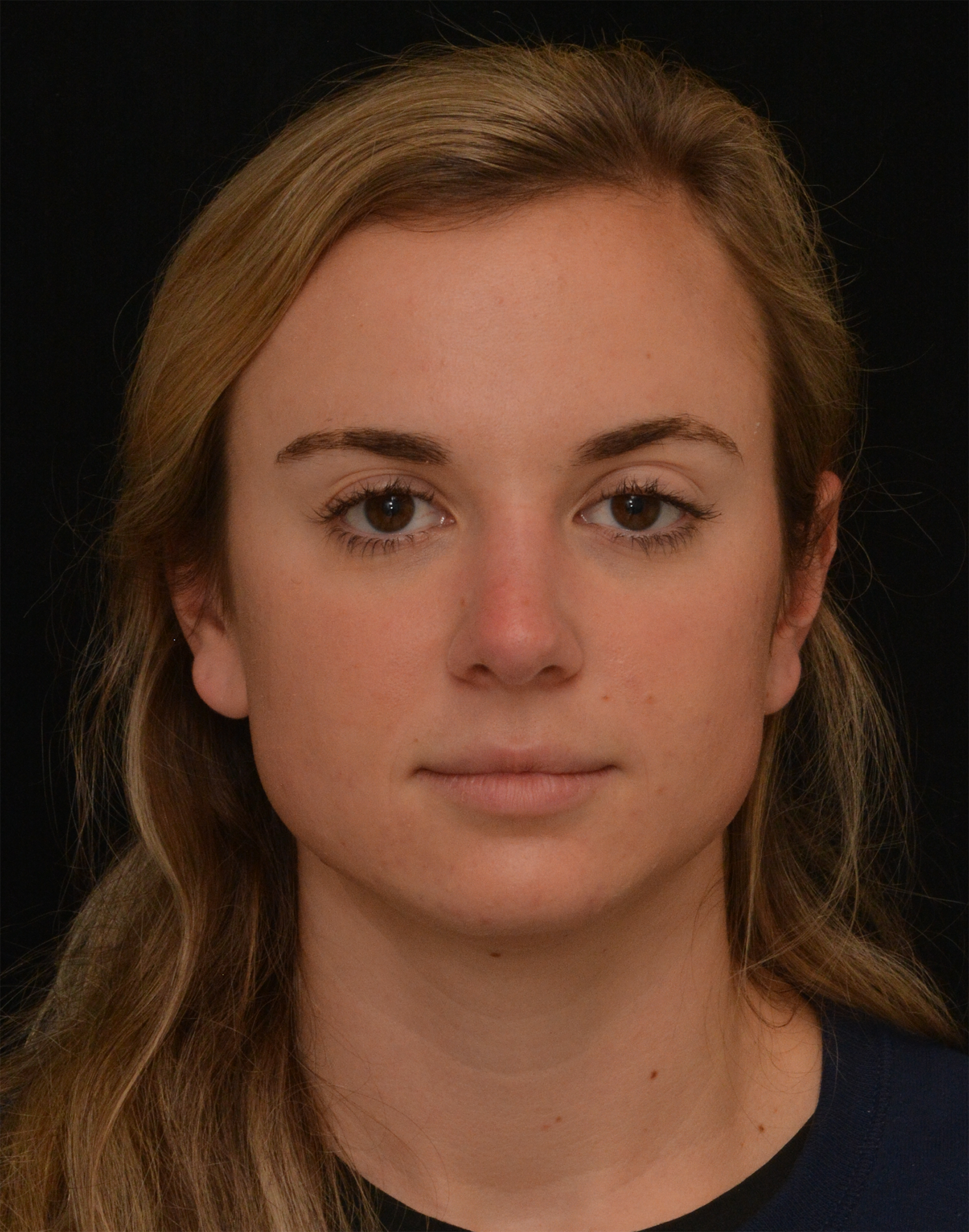 After Image: Rhinoplasty - front