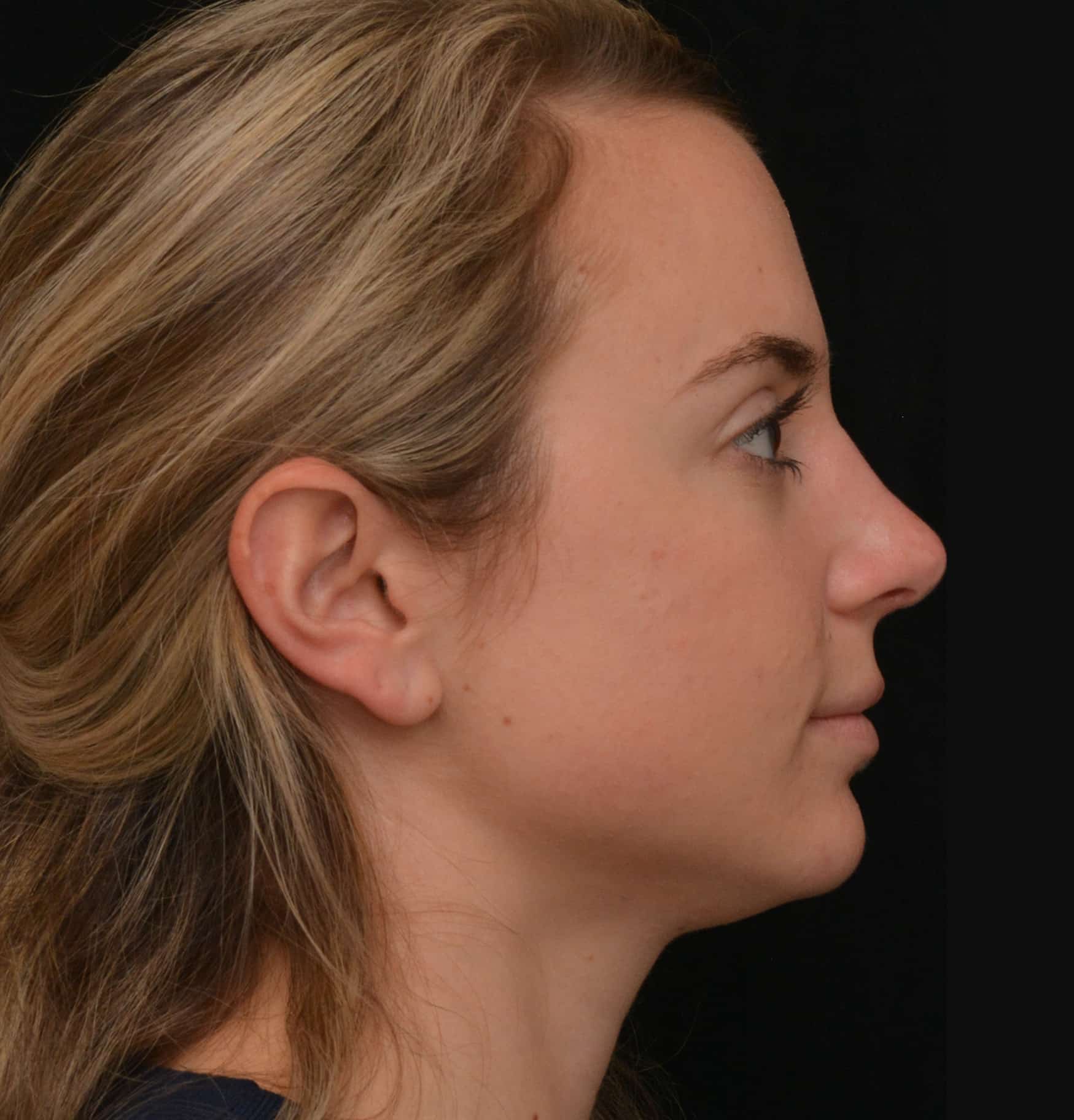 After Image: Rhinoplasty - right-side