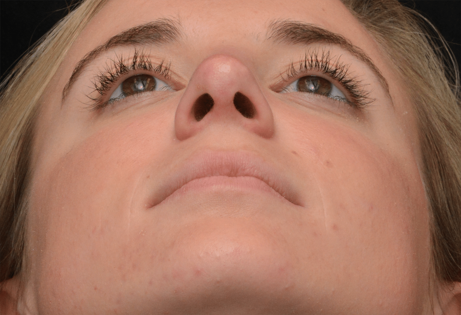 After Image: Rhinoplasty - front