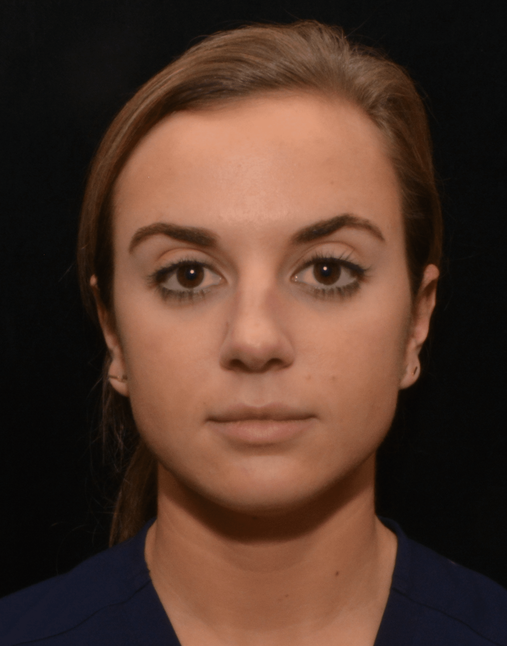 Before Image: Rhinoplasty - front