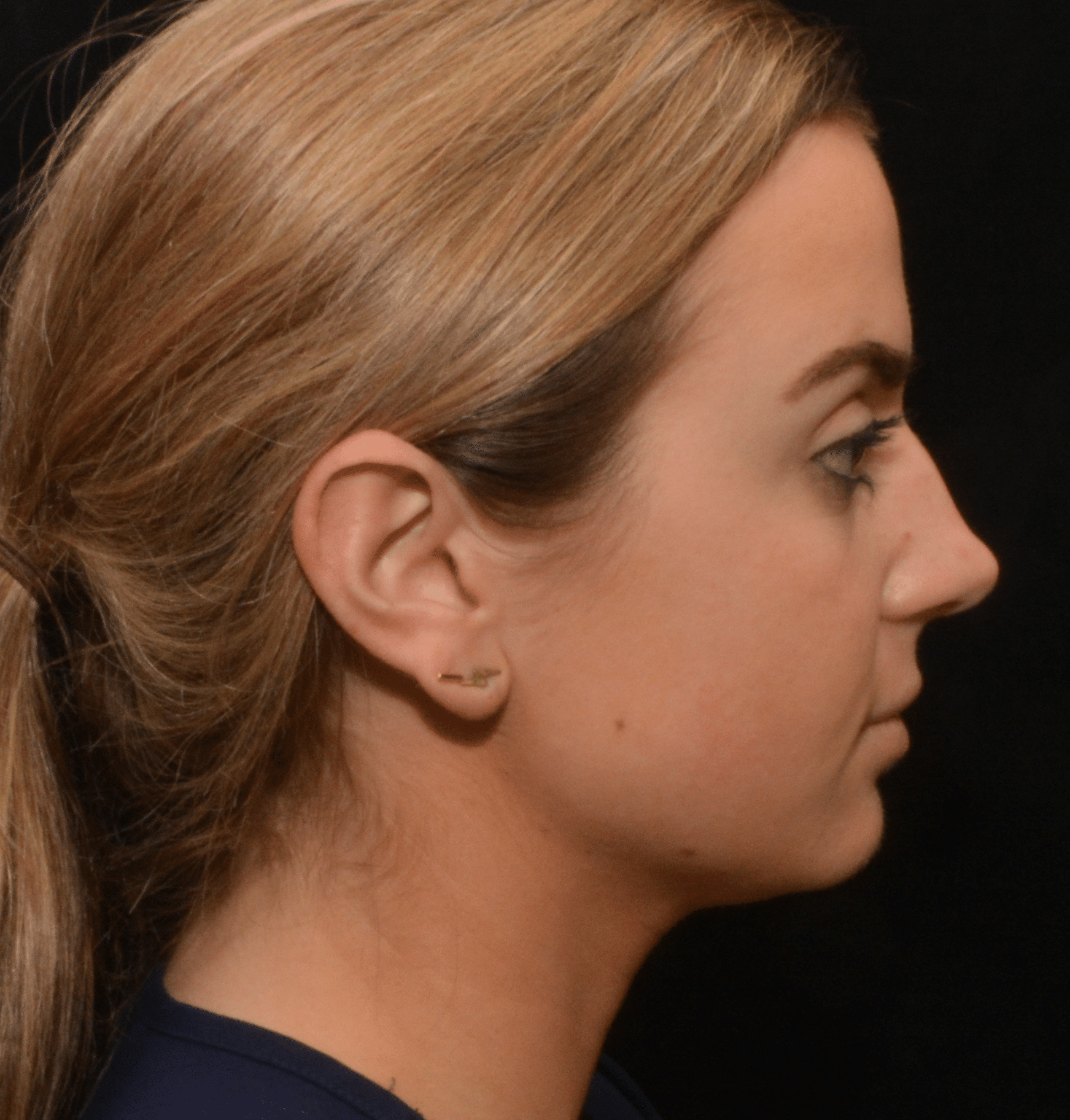 Before Image: Rhinoplasty - right-side