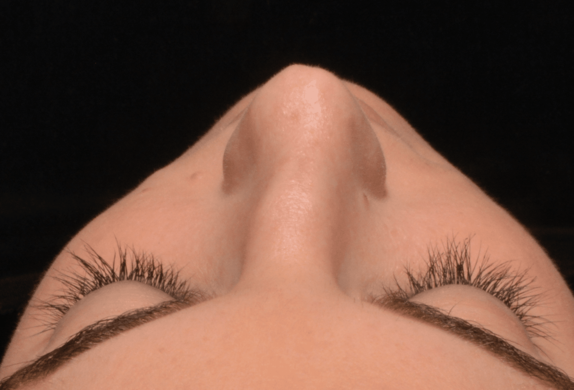 Before Image: Rhinoplasty - front