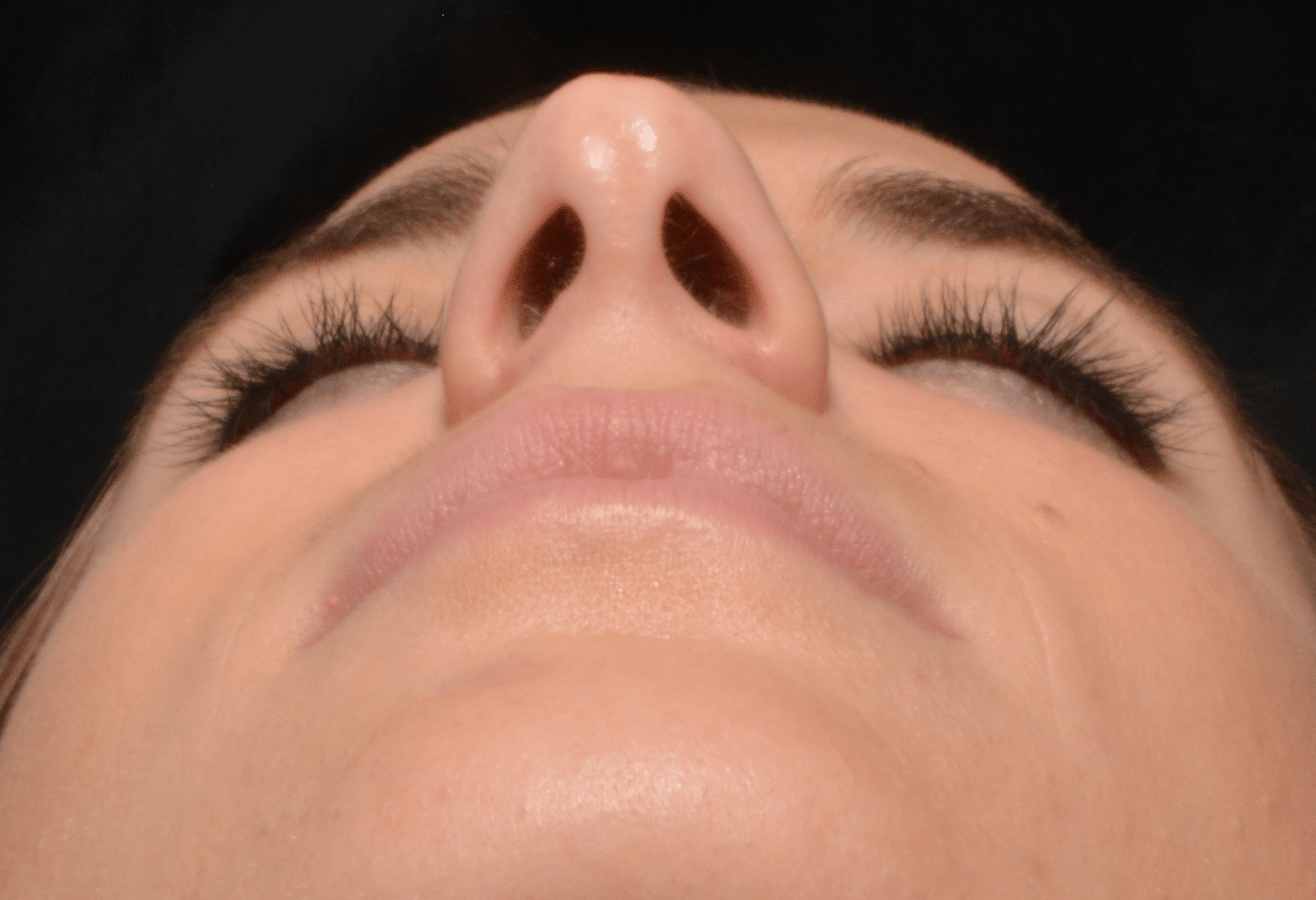 Before Image: Rhinoplasty - front