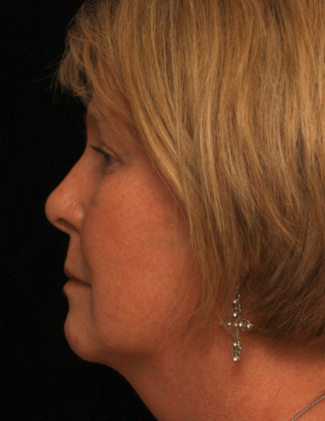 After Image: Upper and Lower Blepharoplasty - left-front-oblique