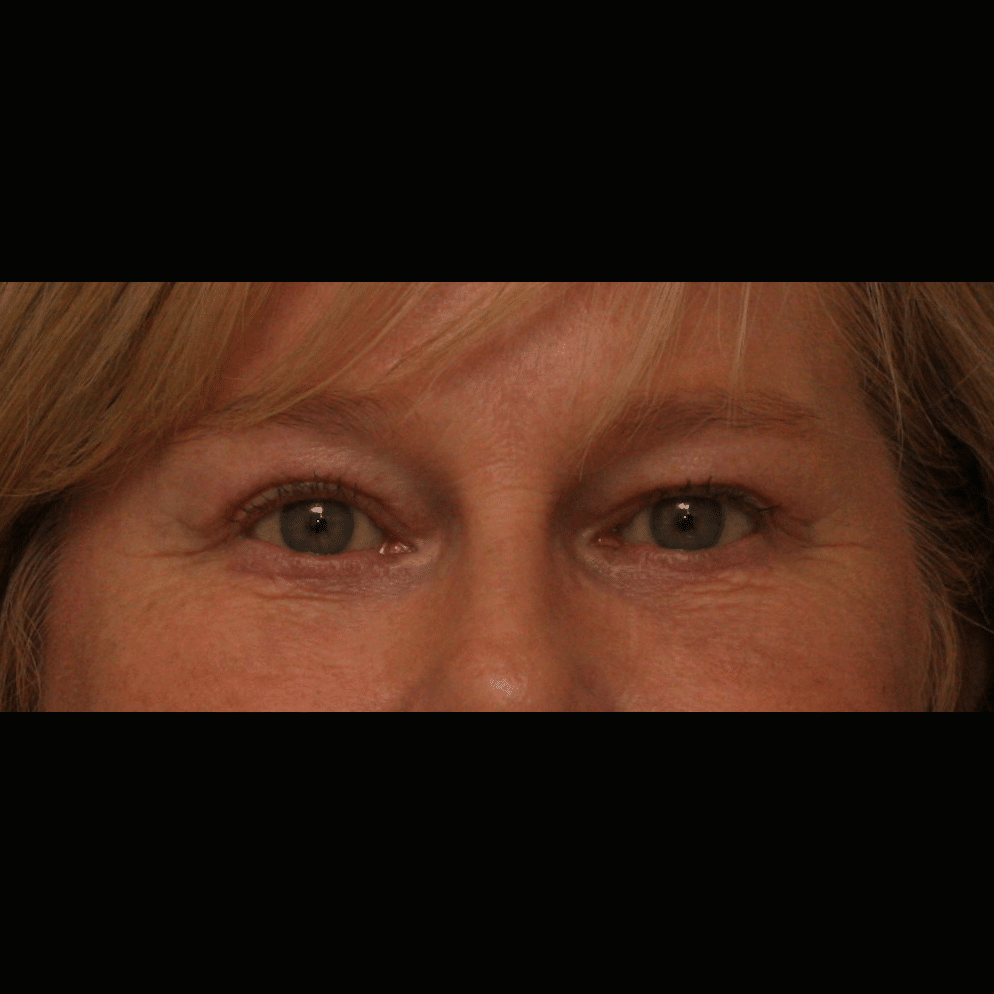 After Image: Upper and Lower Blepharoplasty - front