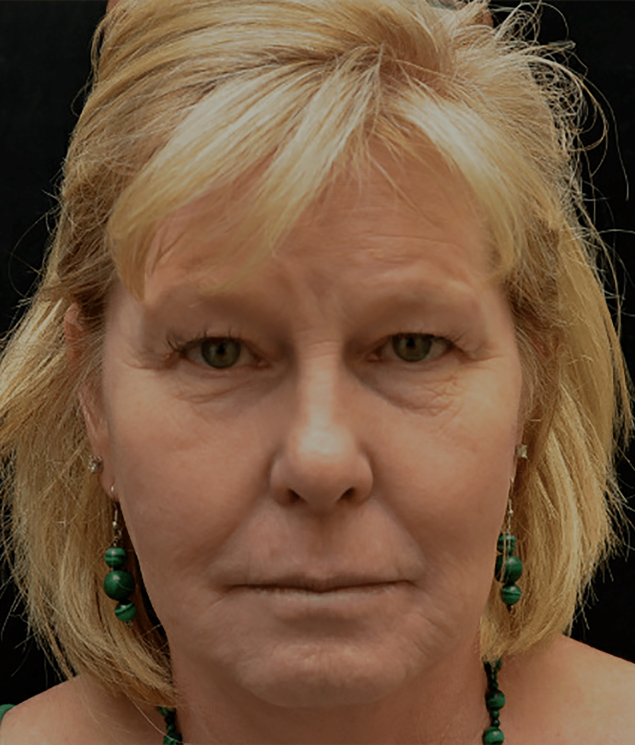 Before Image: Upper and Lower Blepharoplasty - front