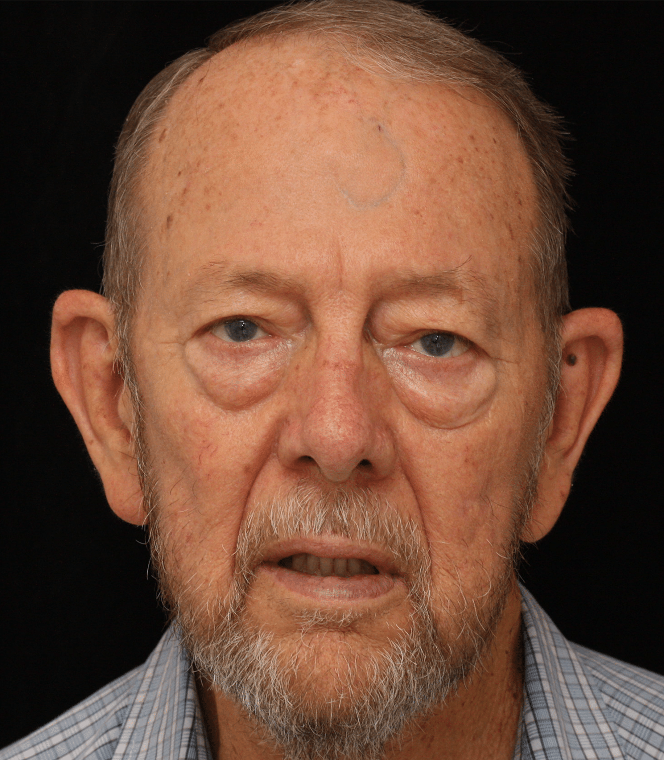 Before Image: Upper and Lower Blepharoplasty - front