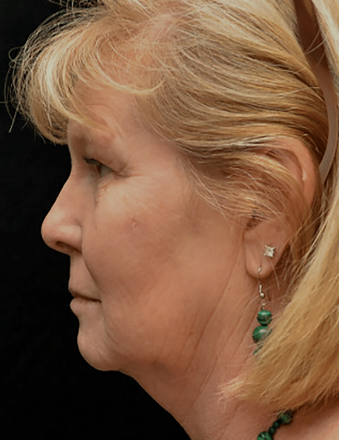 Before Image: Upper and Lower Blepharoplasty - left-front-oblique