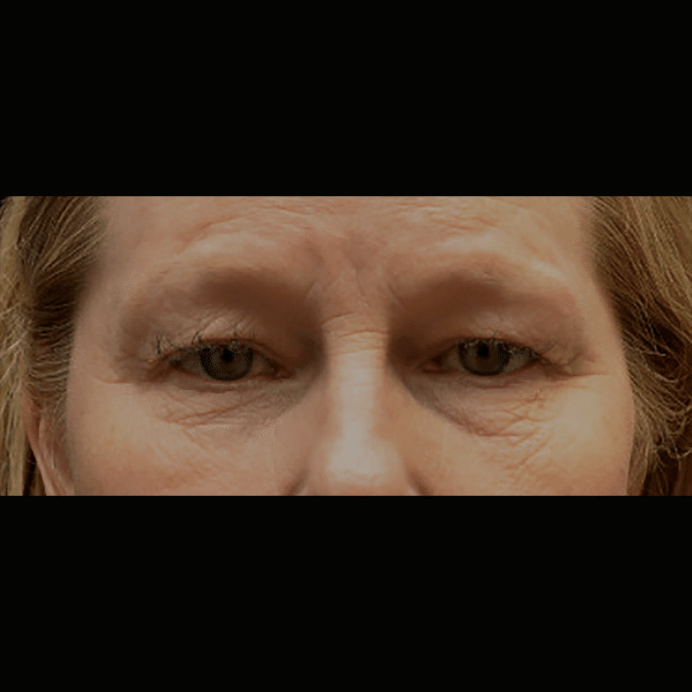 Before Image: Upper and Lower Blepharoplasty - front