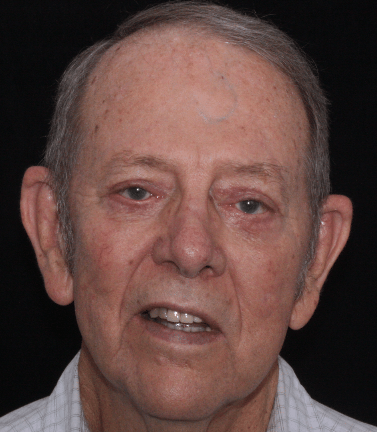 After Image: Upper and Lower Blepharoplasty - front