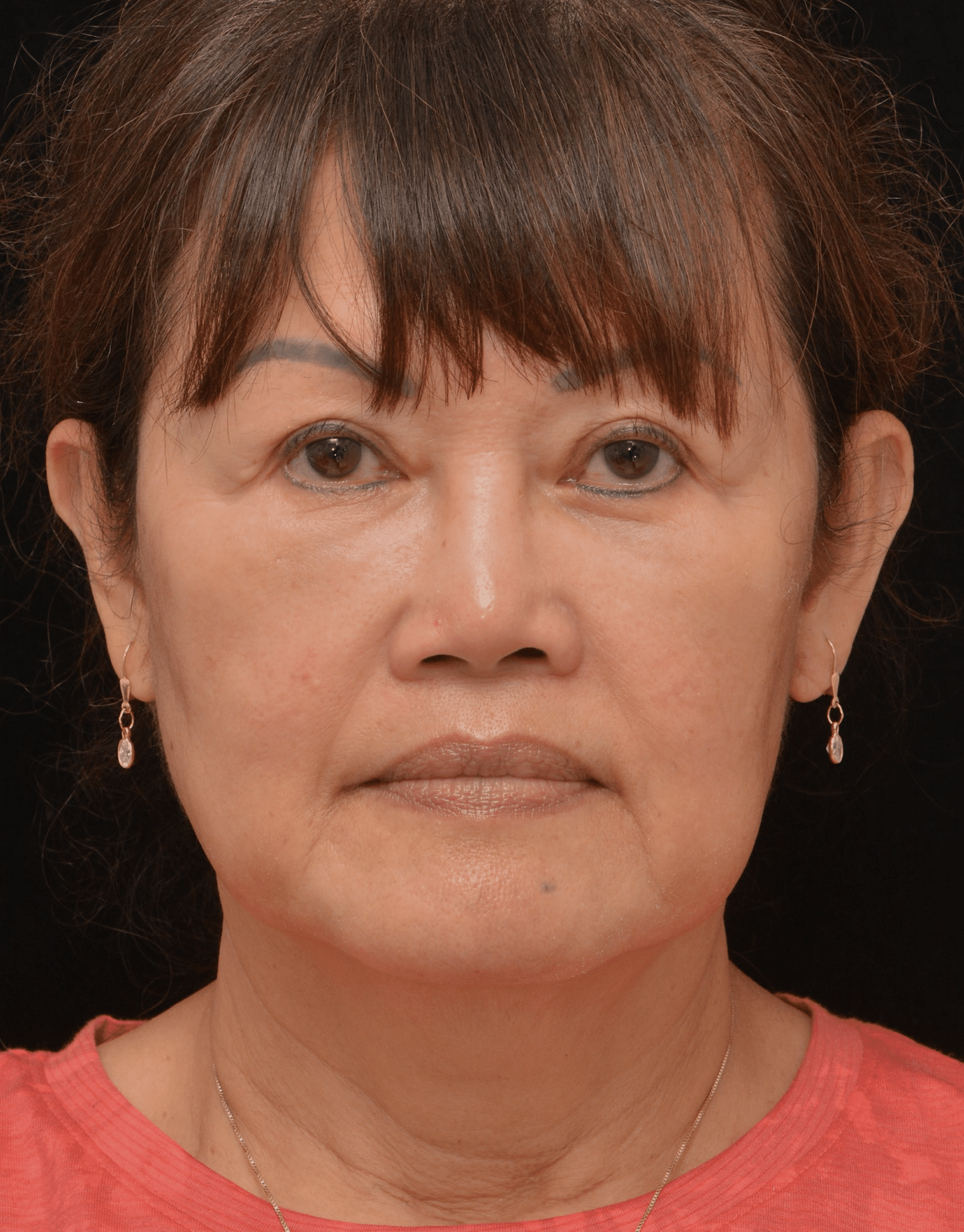 After Image: Upper Blepharoplasty - front