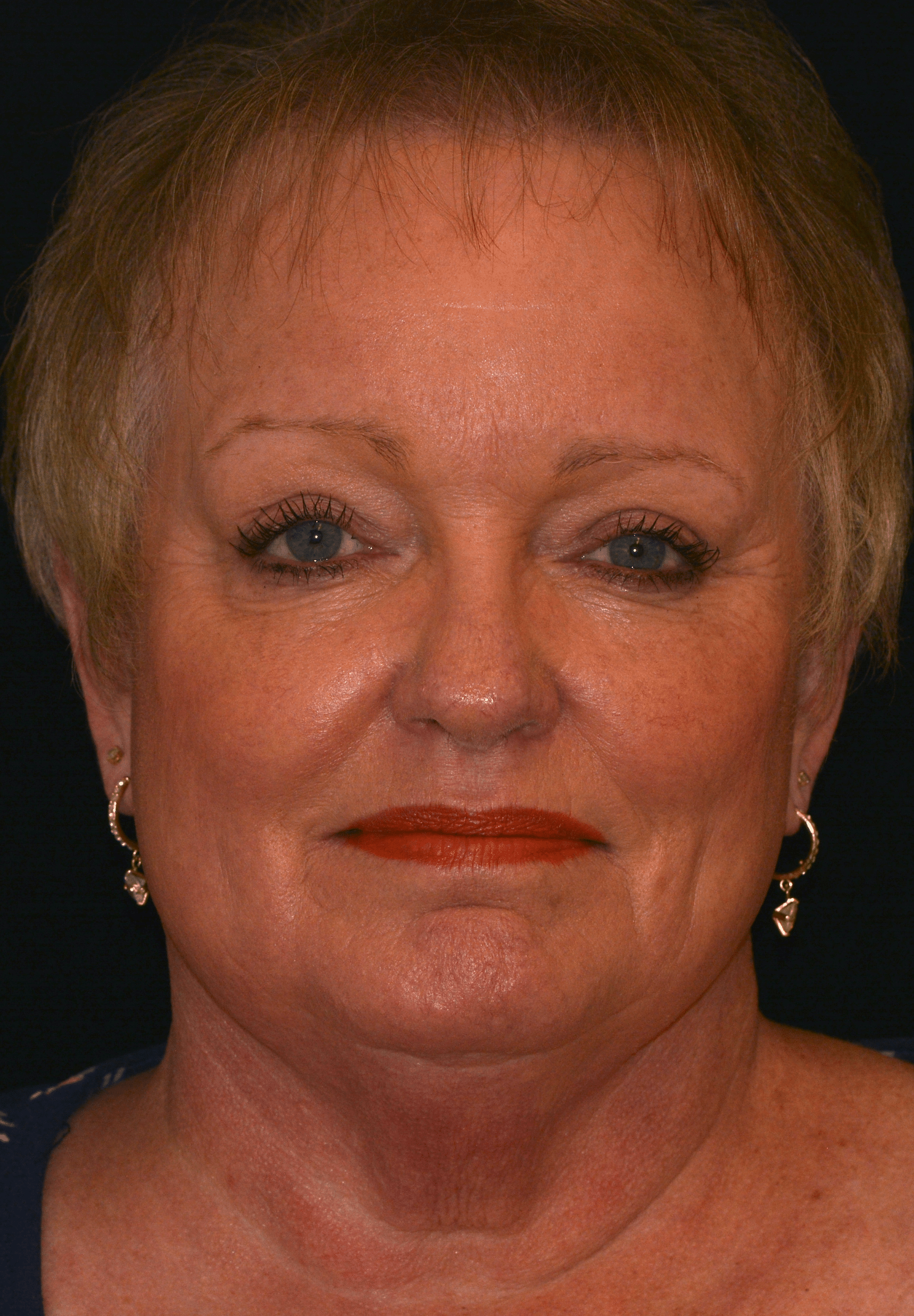 After Image: Upper Blepharoplasty - front