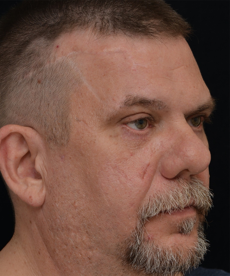 After Image: Upper Blepharoplasty - right-front-oblique