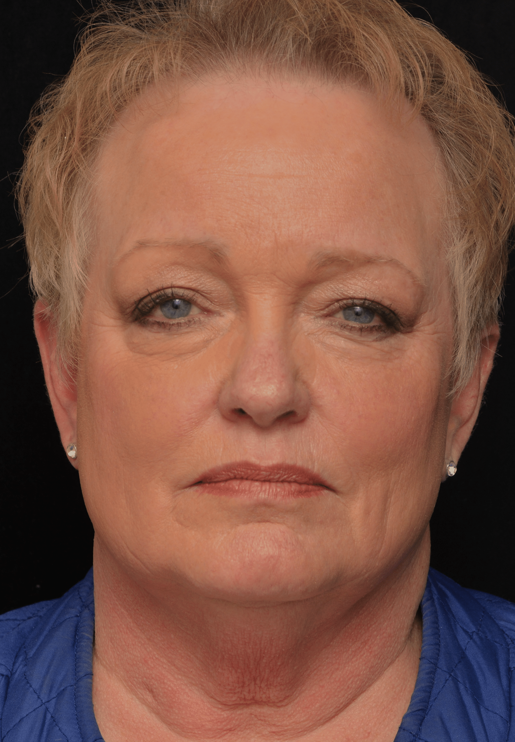 Before Image: Upper Blepharoplasty - front