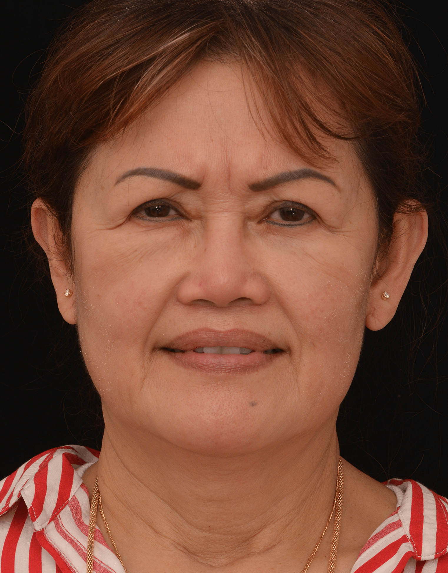 Before Image: Upper Blepharoplasty - front