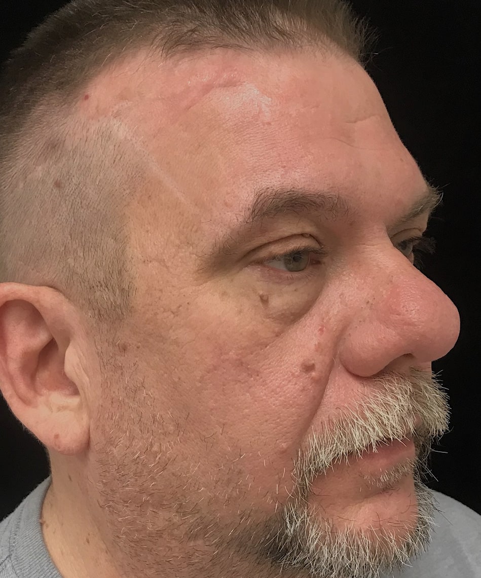 Before Image: Upper Blepharoplasty - right-front-oblique