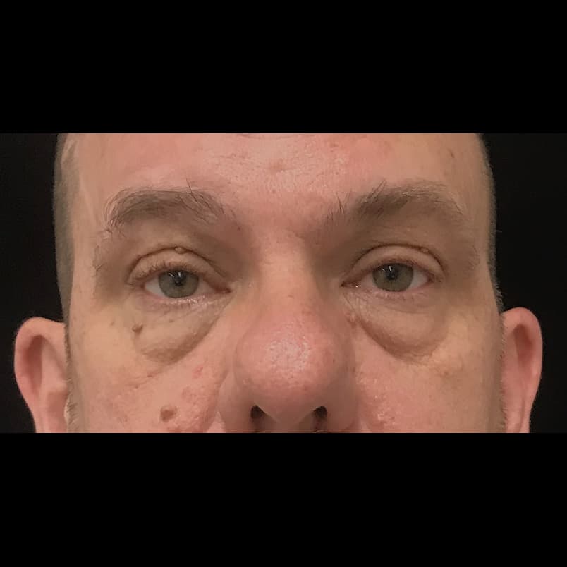 Before Image: Upper Blepharoplasty - front