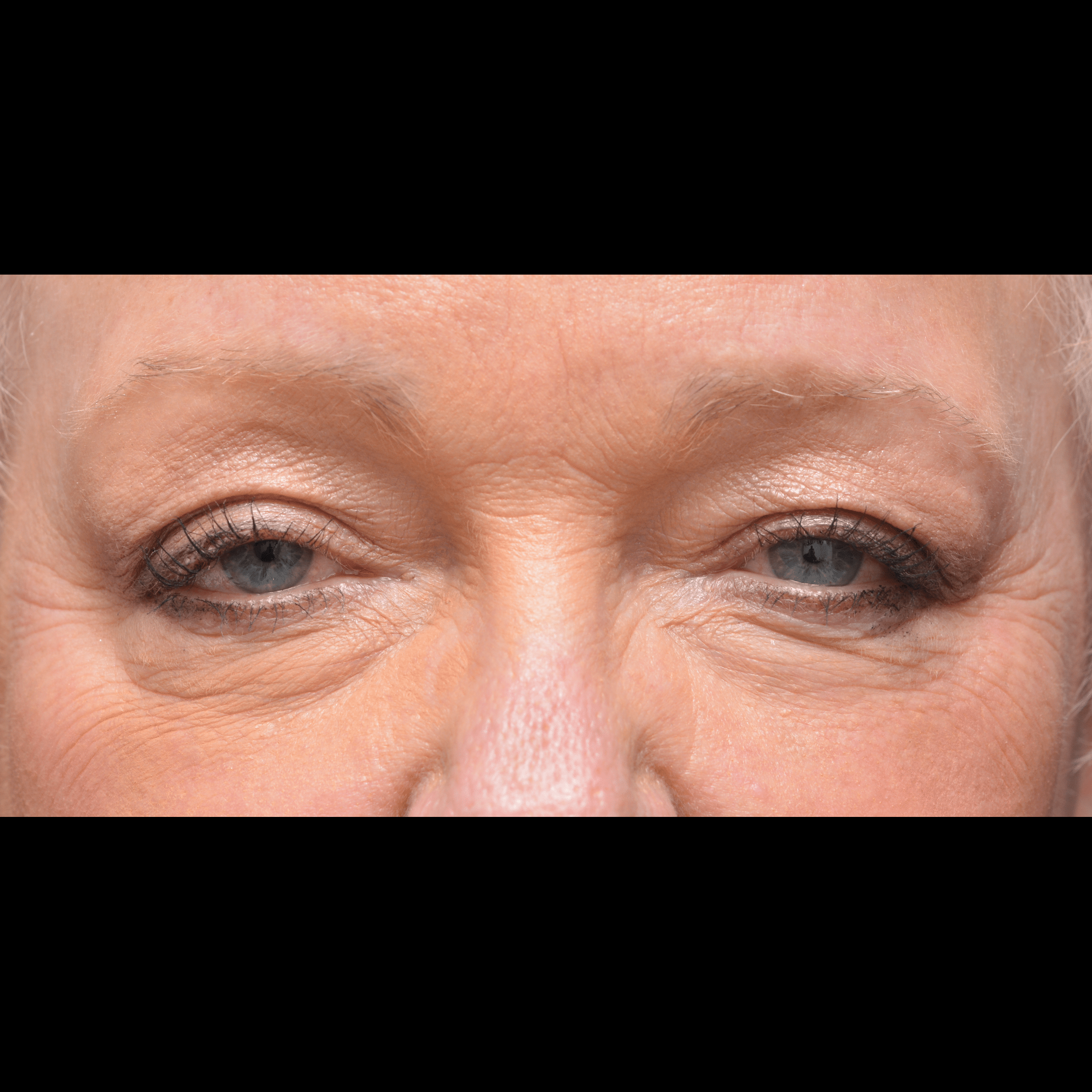 Before Image: Upper Blepharoplasty - front